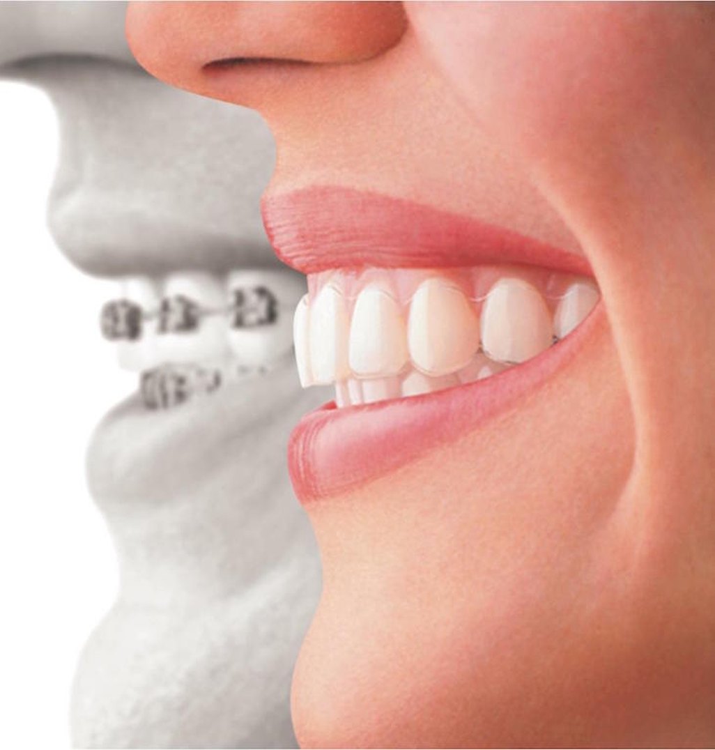 Clear aligner in place