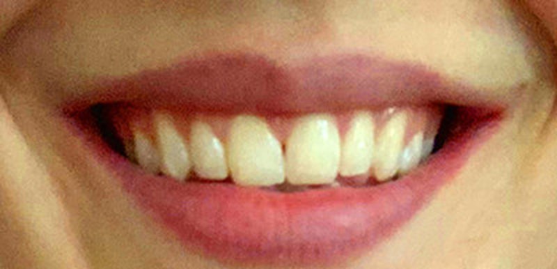 Smile after cosmetic treatment