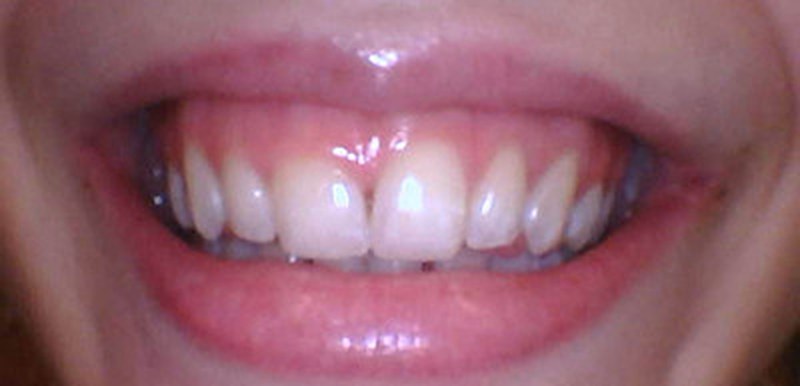 Smile before cosmetic treatment