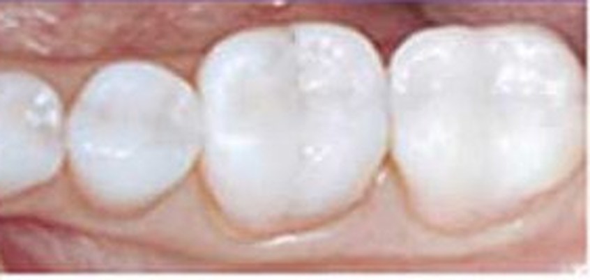 Molars restored with tooth coloured CEREC fillings