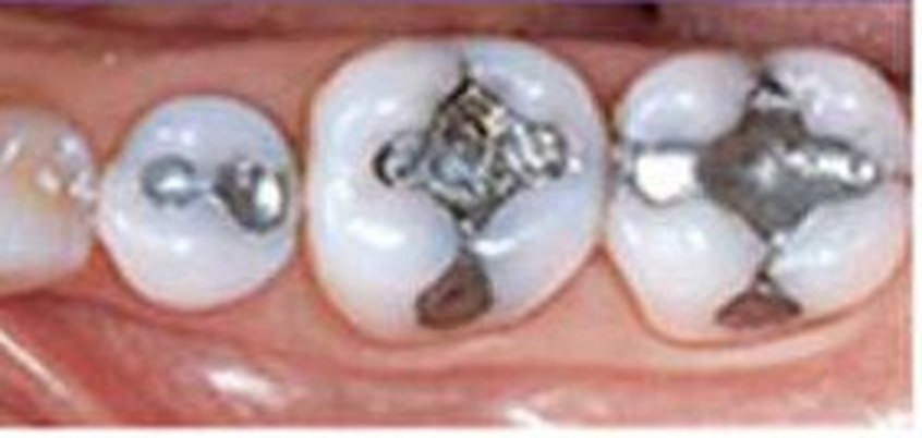 Molars with old silver amalgam fillings